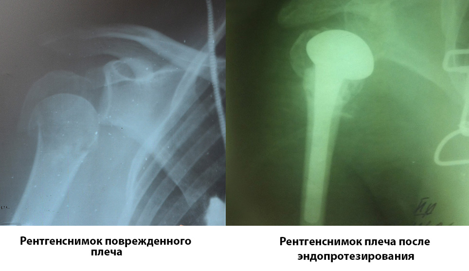 rentgensnimki-do-i-posle-endoprotezirovaniya